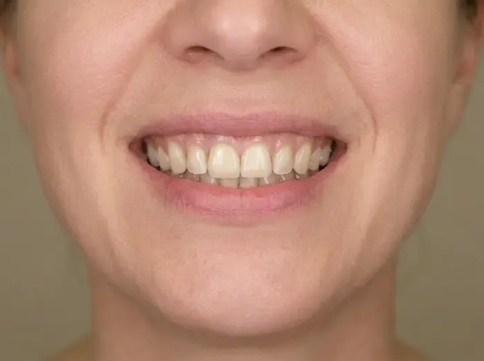 Single-tooth implant — after