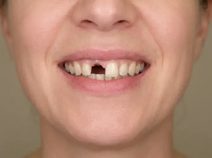 Single-tooth implant — before