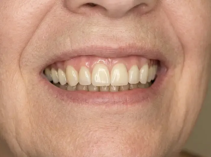 Full-arch (All-on-4) — after