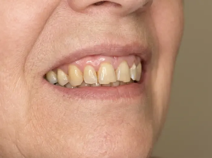 Full-arch (All-on-4) — before