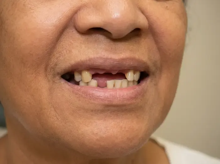 Implant-supported denture — before
